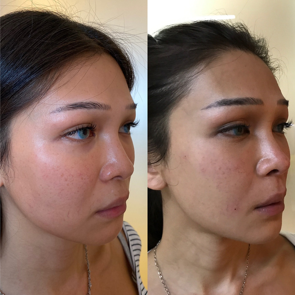 filler occhiaie milano como