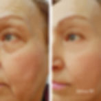 endolift attiva milano como