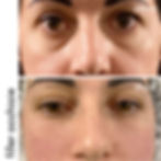 filler occhiaie dr zattoni milano como