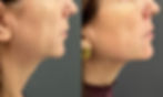 endolift viso prima e dopo eufoton milano como dr zattoni cantù