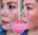 filler occhiaie dr zattoni milano como