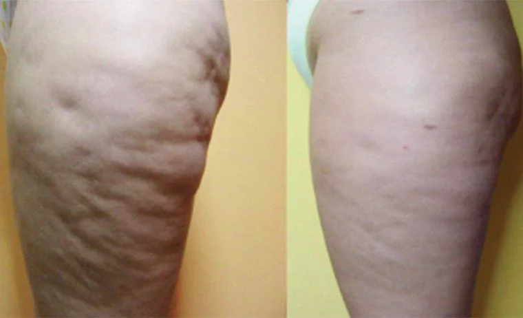mesoterapia cellulite prima e dopo dr Luca Zattoni
