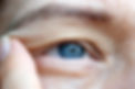 middle aged female's eye with drooping eyelid. Ptosis is a drooping of the upper eyelid, l