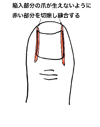 Nailop.gif