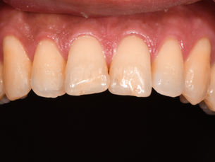 STM Minimal-Prep Laminate Veneers #11 21