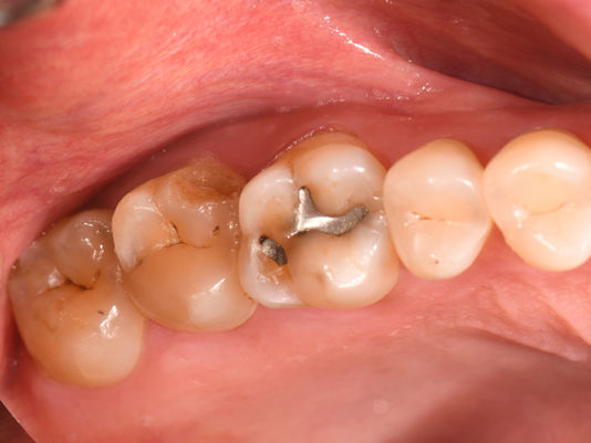 STM Enamel Recovery #17 & STM Inlay #16
