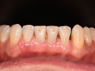 STM No-Prep Laminate Veneers #32 - #33