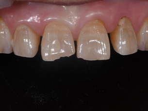 STM Minimal-Prep Laminate Veneers #12 - #22