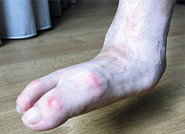 Charcot-voet1.jpg