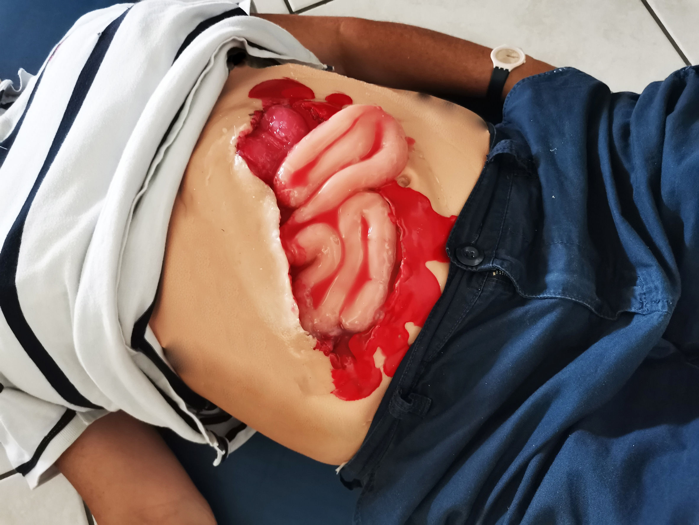 Plaie spéciale éviscération