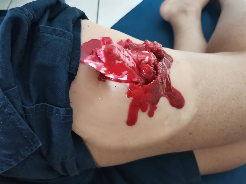 Miniature : Fracture ouverte - fémur
