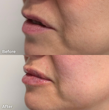 Lip Fillers