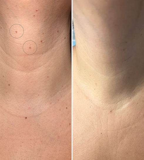Skin-tag-removal-at-Ria-_edited.jpg