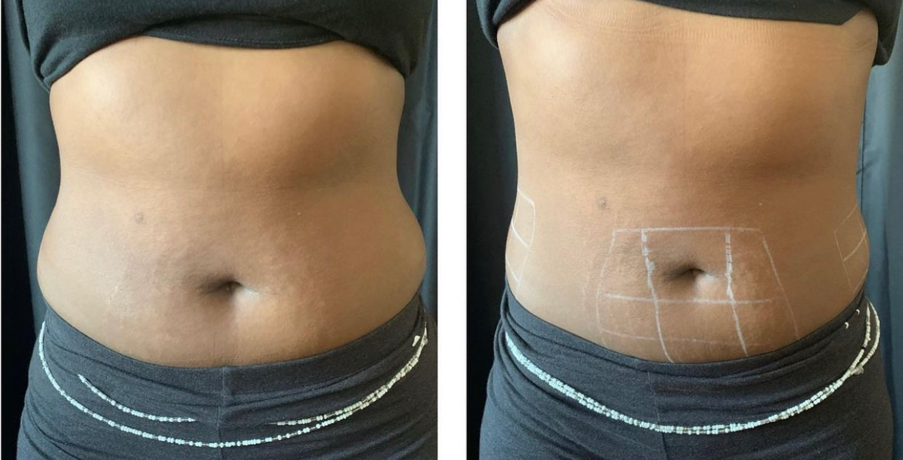 lipo c shot before and after Needleless Liquid Lipo Shots lipo c shot before and after Needleless Liquid Lipo Shots