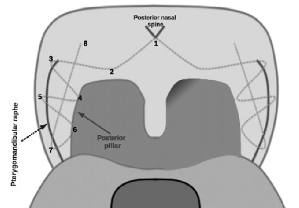 EVOLUTION OF SOFT PALATE SURGERY