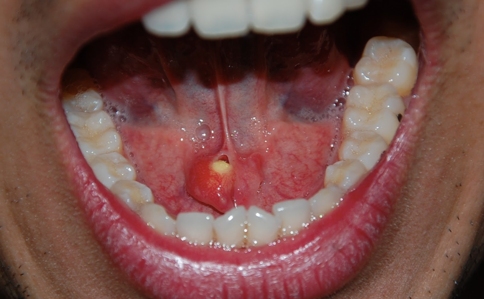 salivary-stones