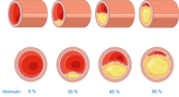 A imagem mostra cortes transversais de uma artéria em diferentes estágios de obstrução devido à aterosclerose. Começa com uma artéria saudável (0% de obstrução) e avança para 30%, 65% e 90% de obstrução por placas de gordura, com a luz do vaso sendo progressivamente diminuída.