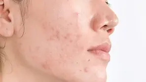 Hiperpigmentação pós-inflamatória