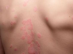 Candidíase cutânea: como identificar a infecção por fungos na pele