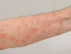 Escabiose: como reconhecer a sarna, tratar corretamente e evitar que ela volte