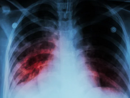 Diretrizes atualizadas para tratamento da tuberculose reduzem duração de regimes terapêuticos
