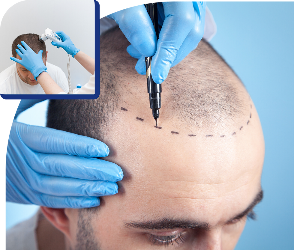 Hair transplant procedure: marking hairline