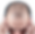 Man's head with receding hairline marked for hair transplant procedure