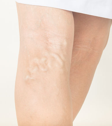 varicose-veins-old-women.jpg