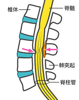 東大宮ほんごう整骨院 脊柱管狭窄症 イラスト2