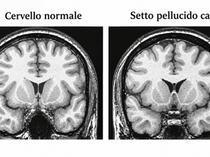 neuropsicologia setto pellucido cavo