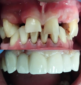 Циркониев Мост