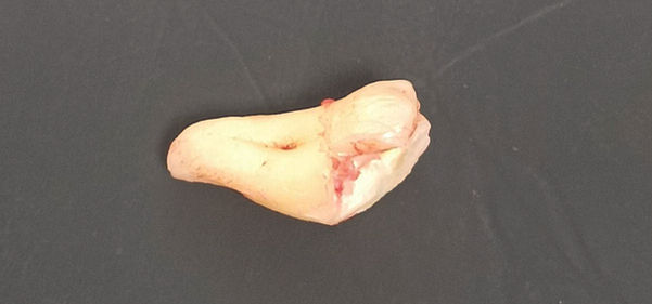 изваден ретиниран мъдрец