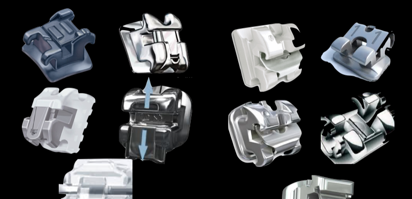 Ceramic self-ligating brackets are NOT better than conventional ceramic brackets!