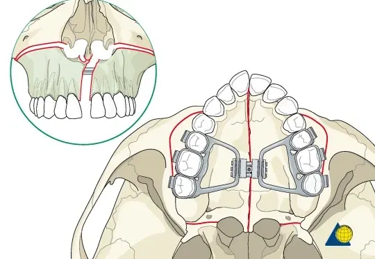 SARPE Activation Protocol: Revise & Review