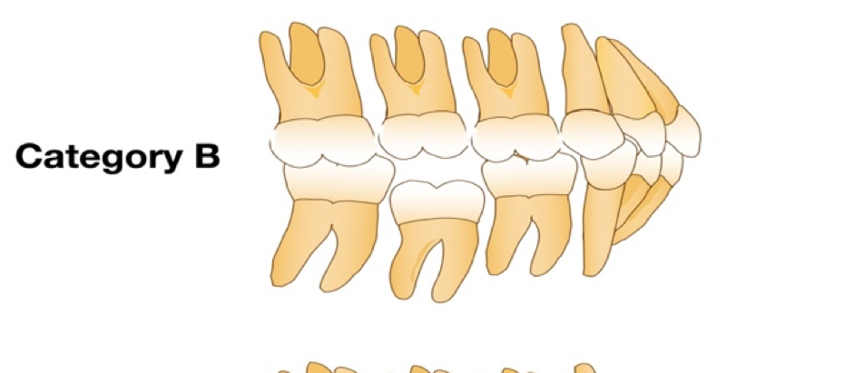 Infraoccluded Primary Molars From an Orthodontic Perspective