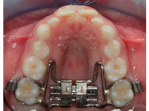 Revise and Review: Retention After Rapid Maxillary Expansion (RME)