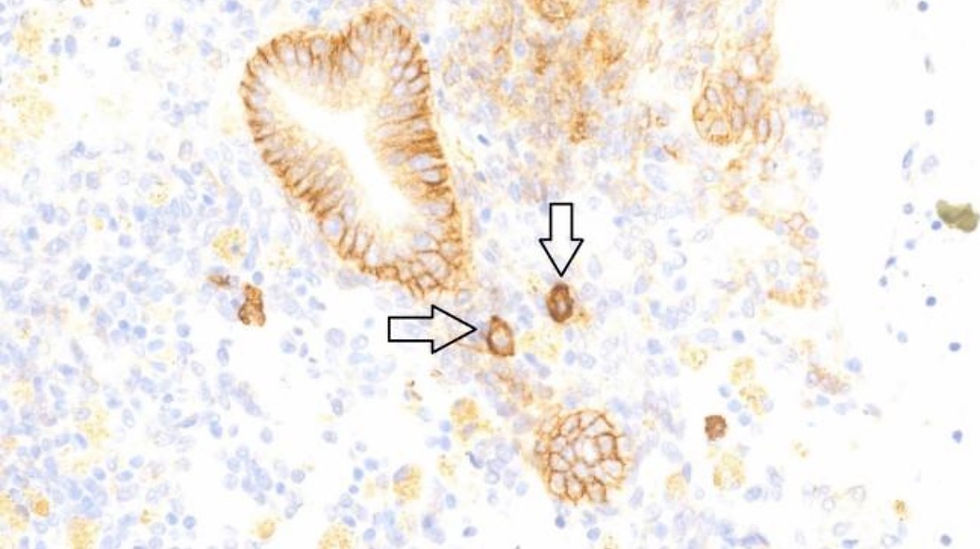 CD138 en PMA : à quoi sert la biopsie de l’endomètre ?