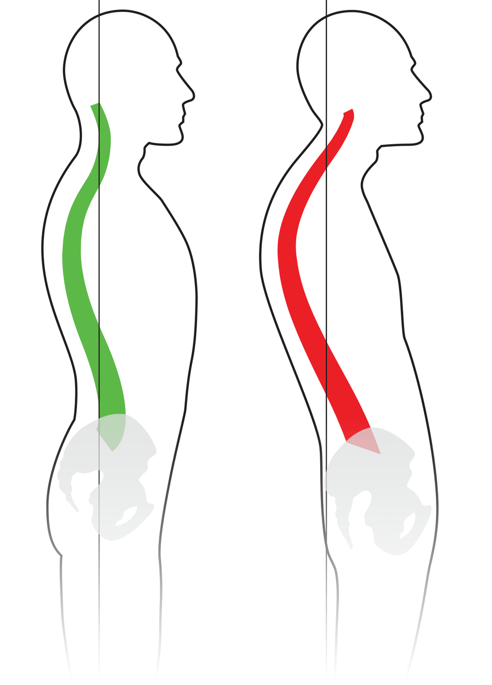 Kyphosis / Kifoz