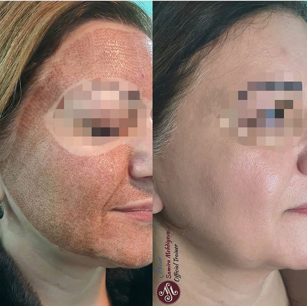 Plexr Full Face Resurfacing