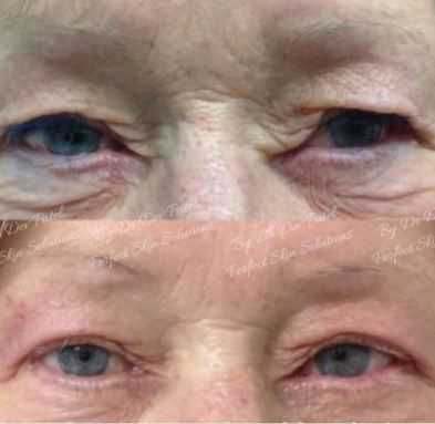 Very mature skin, Blepharoplasty