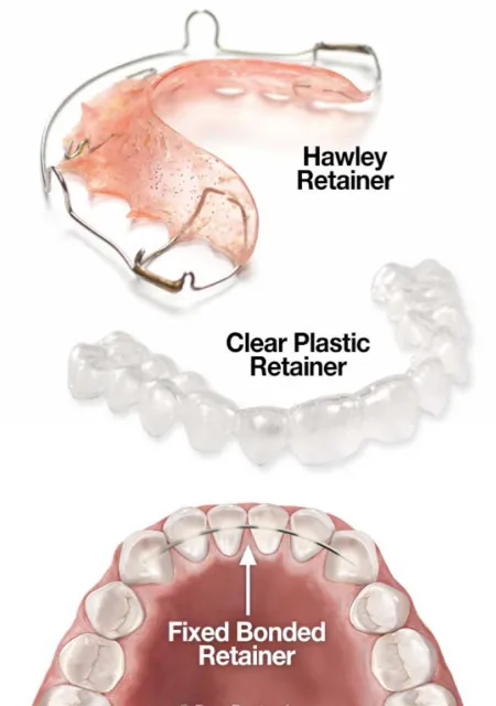 Different types of fixed retainers by Aidencare Dental Orthodontic department