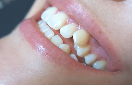 Blanchiment dentaire cosmétique avant après