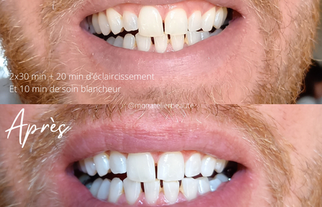 Blanchiment dentaire cosmétique avant après