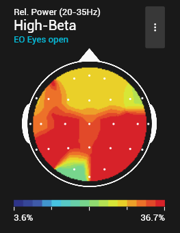 Brain map showing brain wave activity, with higher High Beta activity in the parietal area