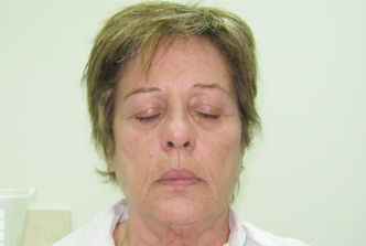 #2 Facial (After)