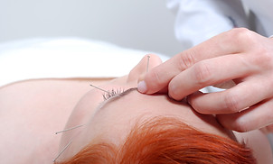 Portrait of a beautiful woman in acupuncture therapy.jpg