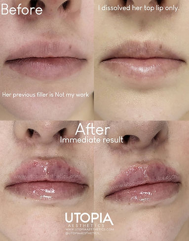 lip filler
