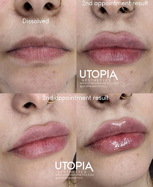 lip filler