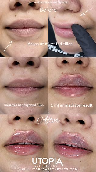 lip filler