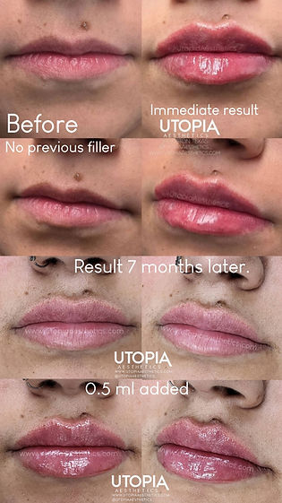 lip filler